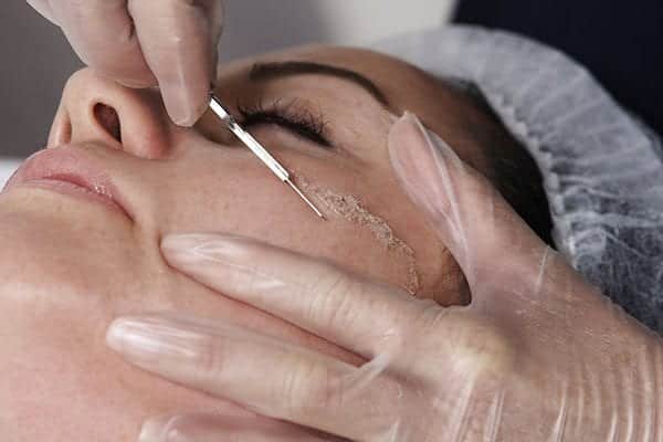 perth dermaplaning