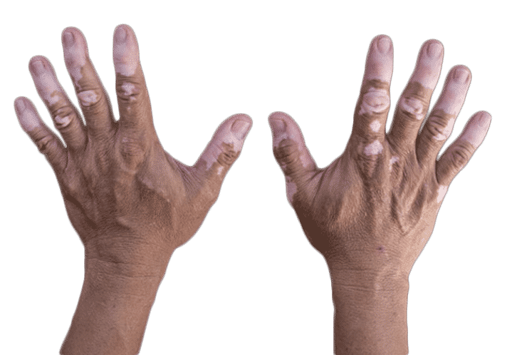 vitiligo treatment perth