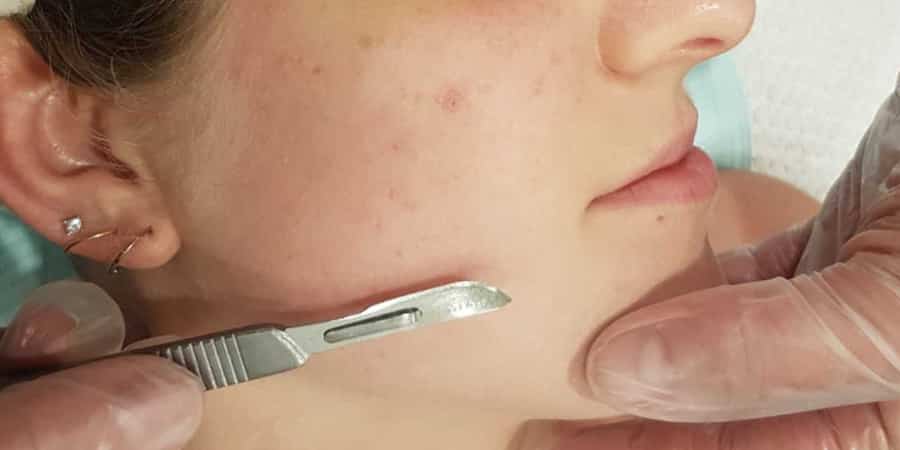 10 How Dermaplaning Can Benefit You