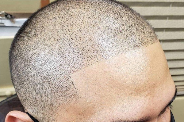 scalp tattoo perth
